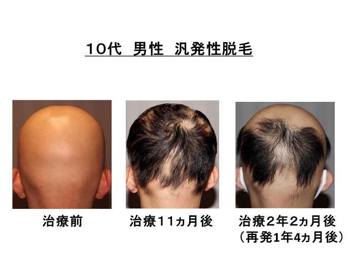円形脱毛症　病院